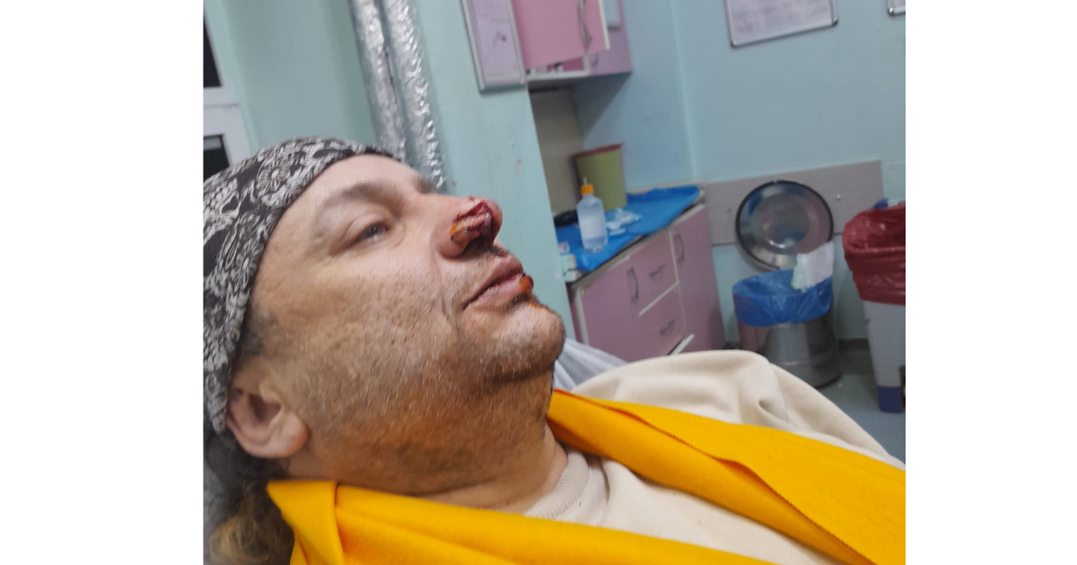 Onur Akay, Köpeğini Korurken Pitbull Saldırısına Uğradı: “Burnumdan Parça Koptu, Kanlar İçindeydim”